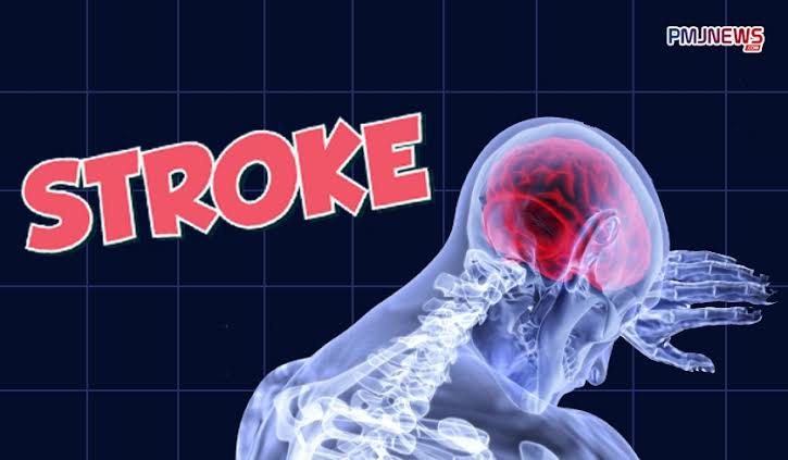 Ilustrasi terkena stroke.