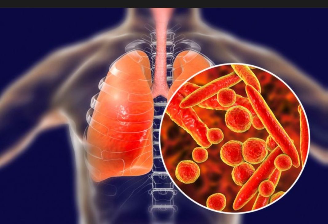 Ilustrasi kasus mycoplasma.