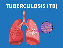 Ilustrasi penyakit TB.